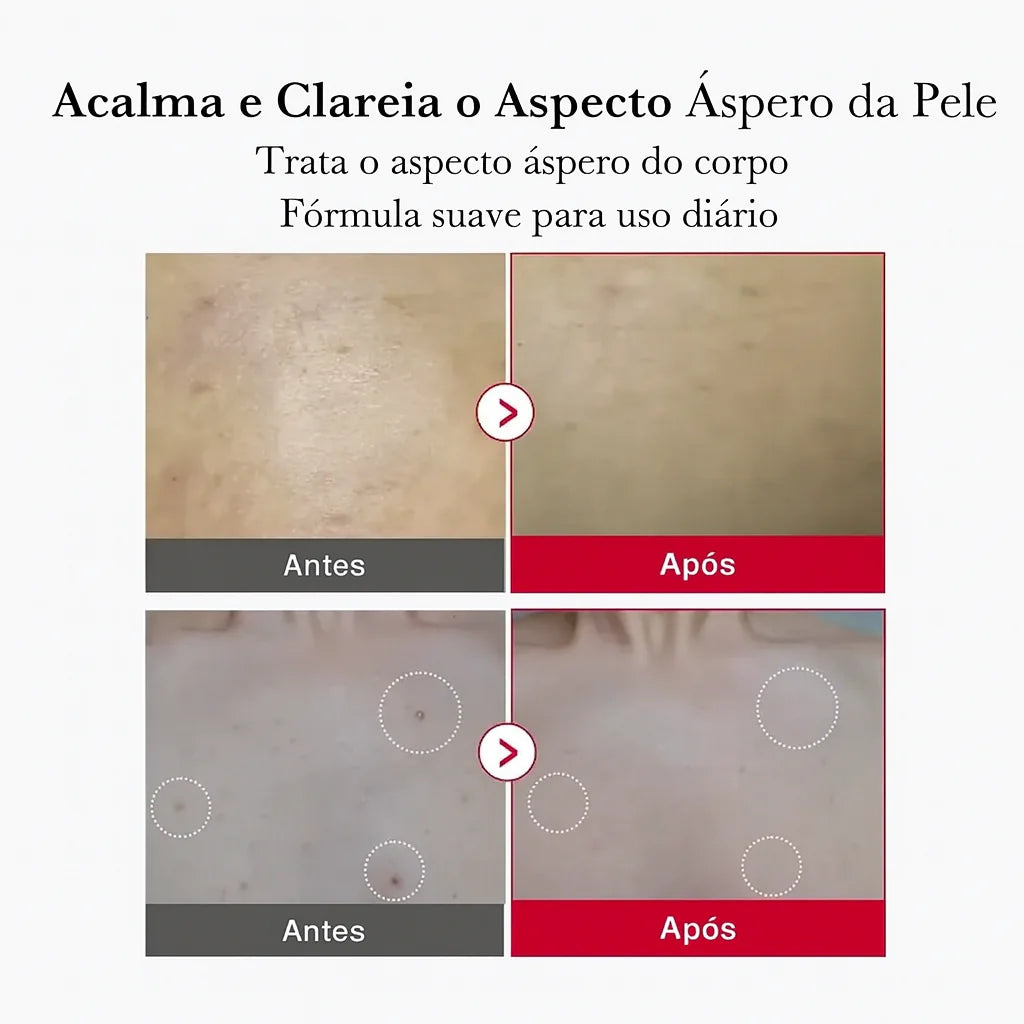 Red Acne Spray Peeling Esfoliante Corporal