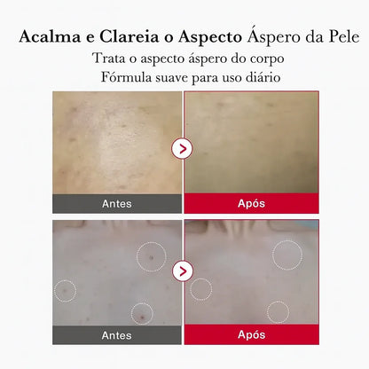 Red Acne Spray Peeling Esfoliante Corporal